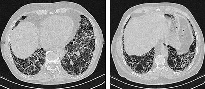 Idiopathische longfibrose: Hardnekkige obstakels